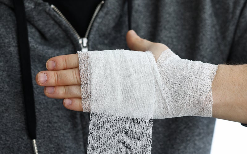 A close-up of a medical professional carefully treating a patient's burn wound, representing the serious medical care required after a burn injury.